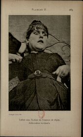 Planche II — Esther sotto l'azione dell'essenza di timo: allucinazioni terrificanti. Occhi spalancati, bocca aperta, espressione di terrore. Confr. con midriasi di Morselli.