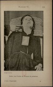 Planche VI — Esther sotto azione di sostanza diversa.